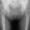 Dual Mobility Total Hip Arthroplasty for Recurrent Dislocation After Femoral Neck Fracture in an Elderly Patient: A Case Report