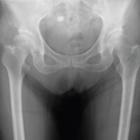 Figure 1: Pre-operative anteroposterior radiograph showing a displaced Garden Type III femoral neck fracture.
