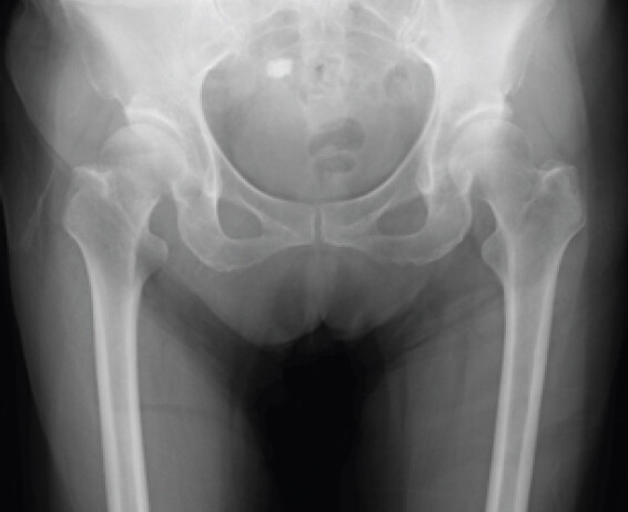 Figure 1: Pre-operative anteroposterior radiograph showing a displaced Garden Type III femoral neck fracture.