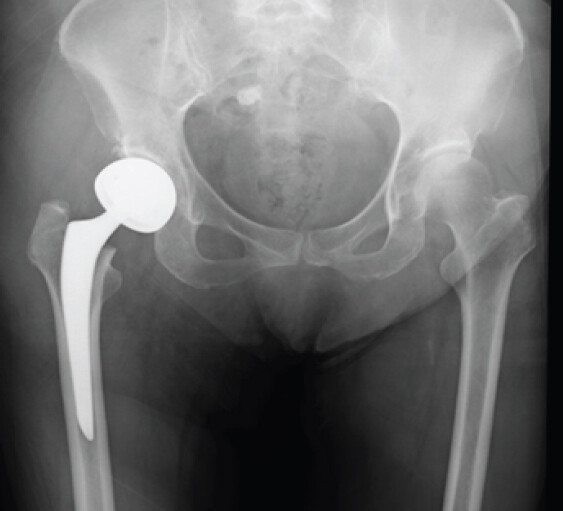 Figure 2: Post-operative radiograph after bipolar hemiarthroplasty performed through a posterior approach.