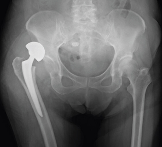 Figure 3: Radiograph showing posterior dislocation of the bipolar hemiarthroplasty 3 months after the initial surgery.