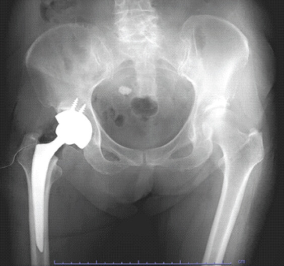 Figure 4: Post-operative radiograph after conversion total hip arthroplasty using a Zimmer Biomet G7 dual mobility cup. The acetabular cup was placed with an inclination angle of 49° and an anteversion angle of 19°.