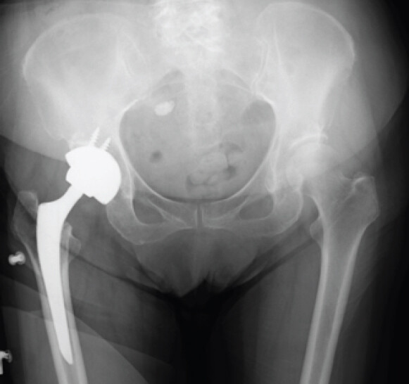 Figure 5: Radiograph at the 2-year follow-up showing stable implant fixation without redislocation.