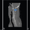 Combined Ultrasound- and Fluoroscopy-guided Percutaneous Cementoplasty and Ablation for a C2 Pathologic Fracture: A Case Report