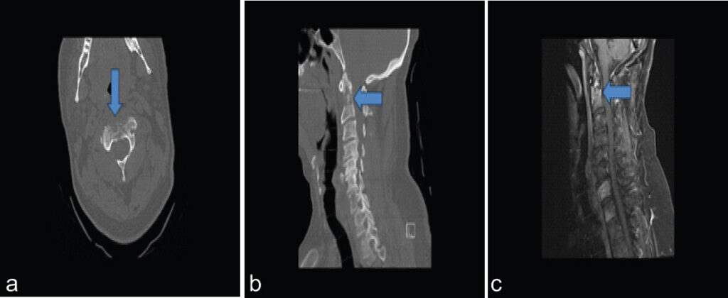 Figure 1: Pre-operative computed tomography (CT) and magnetic resonance imaging (MRI) demonstrating a C2 lytic lesion and pathologic dens fracture: Axial (a) and sagittal (b) CT images of the cervical spine demonstrate a destructive lytic lesion in C2 with a non-displaced type II dens fracture (arrow). Sagittal MRI with gadolinium revealed an enhancing metastatic lesion with marrow replacement within C2 (c, arrow).