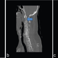 Figure 1: Pre-operative computed tomography (CT) and magnetic resonance imaging (MRI) demonstrating a C2 lytic lesion and pathologic dens fracture: Axial (a) and sagittal (b) CT images of the cervical spine demonstrate a destructive lytic lesion in C2 with a non-displaced type II dens fracture (arrow). Sagittal MRI with gadolinium revealed an enhancing metastatic lesion with marrow replacement within C2 (c, arrow).