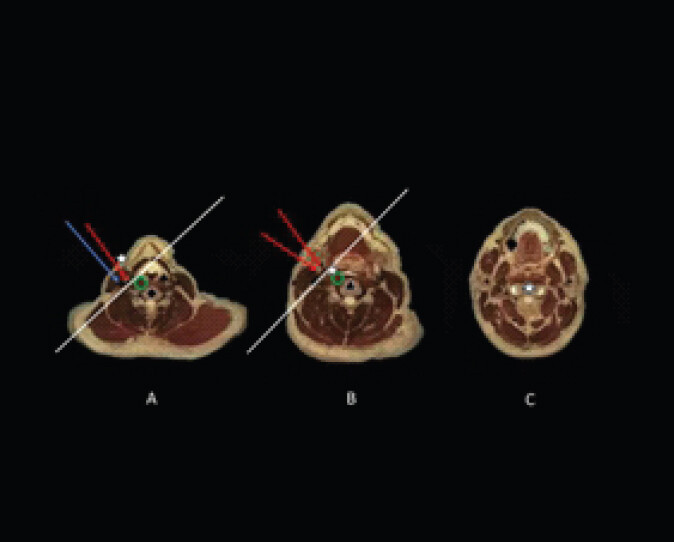 Figure 2: Anatomical mapping and trajectory planning of the novel anterolateral percutaneous approach to C2: Axial computed tomography cadaveric images labeled to demonstrate a novel percutaneous approach to C2. Skin entry site (a) at C5 (diamond), caudal to the carotid bifurcation. The skin entry site (star) is medial to the common carotid artery (red arrow) and jugular vein (blue arrow) and anterolateral to the midline spine. The angle of entry is cephalad and medial toward the longus colli muscle (green circle). The plane medial to the vessels must be reached before the level of the carotid bifurcation to avoid small branches not visible with ultrasound. Axial level (b) at the level of the carotid bifurcation (red arrows) demonstrates that the needle tip (star) is medial to the vessels at this point – approximately C4 (triangle). From here until the target the only structure left to traverse is the longus colli muscle (green circle). Axial image (c) at the level of C2 (cross) demonstrating needle deep to longus colli at target (star). Images used with permission (Micheau A, Hoa D, e-Anatomy, www.imaios.com, DOI: 10.37019/e-anatomy).