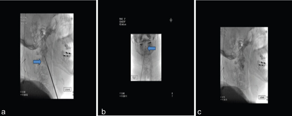 Figure 3: Intraoperative biplanar fluoroscopy confirming trocar advancement, RF ablation probe placement, and final cement interdigitation: Lateral image demonstrated successful advancement of the trocar to the inferior endplate of C2 with subsequent drilling (arrow) to create a tract within the C2 vertebral body toward the dens (a). Anterior-posterior fluoroscopy image showed placement of radiofrequency ablation probe (arrow) advanced through the trocar terminating at the base of the dens (b). Immediate post-procedure image confirming successful interdigitation of cement within C2 (c).