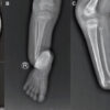 Multimodal Biological Augmentation with Umbilical Cord Mesenchymal Stem Cell Secretome, Recombinant Human Bone Morphogenetic Protein-2, and Allogeneic Umbilical Cord Mesenchymal Stem Cells in Neurofibromatosis Type 1-Confirmed Congenital Pseudarthrosis of the Distal Tibia and Fibula: A Case Report with Mechanistic Scoping Review