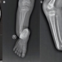 Figure 1: Pre-operative radiographs: (a) standing anteroposterior whole-leg radiograph demonstrating right limb length discrepancy with shortening and valgus deformity at the level of the pseudarthrosis. The left cruris also showed distal fibula pseudarthrosis. (b) Anteroposterior radiograph of the right cruris. (c) Lateral radiographs of the right cruris. Crawford type IV congenital pseudarthrosis of the tibia: Atrophic pseudarthrosis of the distal tibia with severe anterior bowing, sclerotic tapered bone ends, and concurrent pseudarthrosis of the distal fibula – no callus formation.