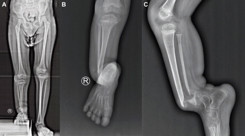 Figure 1: Pre-operative radiographs: (a) standing anteroposterior whole-leg radiograph demonstrating right limb length discrepancy with shortening and valgus deformity at the level of the pseudarthrosis. The left cruris also showed distal fibula pseudarthrosis. (b) Anteroposterior radiograph of the right cruris. (c) Lateral radiographs of the right cruris. Crawford type IV congenital pseudarthrosis of the tibia: Atrophic pseudarthrosis of the distal tibia with severe anterior bowing, sclerotic tapered bone ends, and concurrent pseudarthrosis of the distal fibula – no callus formation.