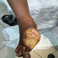 Figure 1: Pre-operative clinical photograph demonstrating gangrenous changes of the right forefoot with extensive necrosis.
