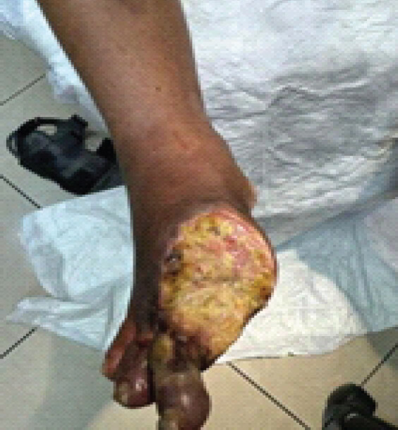 Figure 1: Pre-operative clinical photograph demonstrating gangrenous changes of the right forefoot with extensive necrosis.