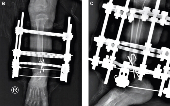 Figure 2: Post-operative radiographs: (a) Anteroposterior cruris showing Ilizarov construct with tibial rings, crossed K-wires at pseudarthrosis site, and threaded rods; (B) foot axial view showing trans-ankle foot ring configuration – hardware in position; no acute complication.