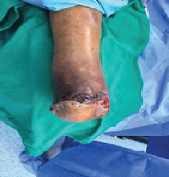 Figure 2: Immediate post-operative clinical photograph following proximal midfoot (Lisfranc) amputation, showing local flap coverage with stable wound margins and preservation of a plantigrade foot.