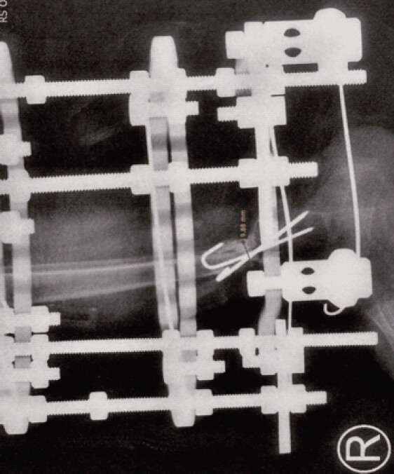 Figure 3: Lateral radiograph at 6 months (May 16, 2026). Digital measurement: tibial callus anteroposterior diameter 9.88 mm. Ilizarov frame intact. No graft resorption.