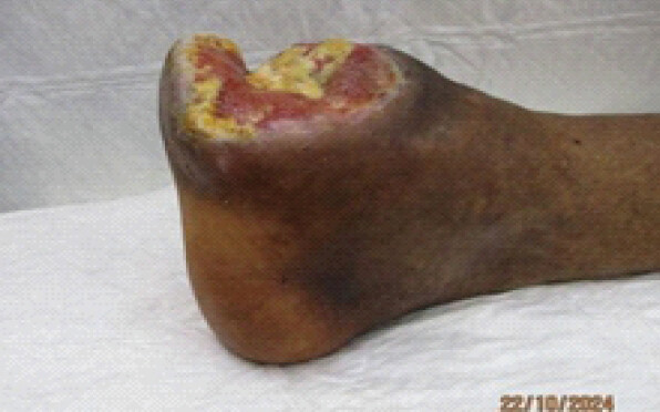 Figure 3: Post-operative clinical photograph demonstrating wound dehiscence with partial separation of the surgical incision and exposed soft tissue.