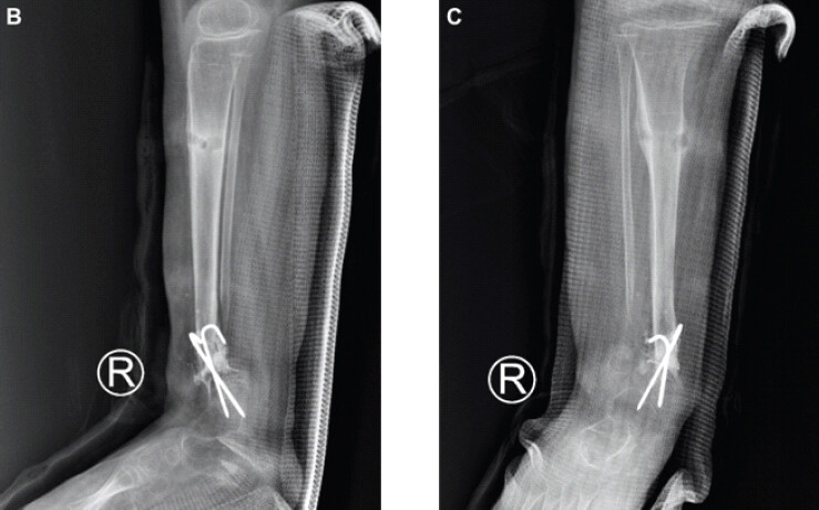Figure 4: Post-frame-removal radiographs at 8 months (July 19, 2026): (a) Anteroposterior and (b) lateral projections. Bridging callus at tibial pseudarthrosis site; cortical continuity forming; anterior bowing improved. K-wires retained at distal tibial site. Fibular site: ongoing healing, no internal fixation. No refracture.