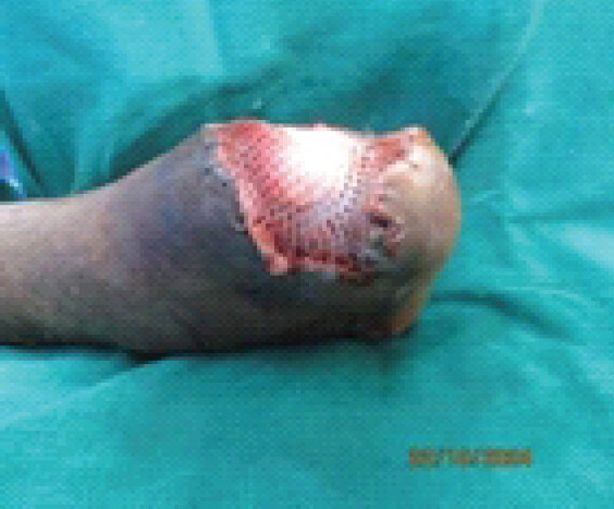 Figure 4: Intraoperative clinical photograph showing placement of acellular dermal matrix over the midfoot wound.