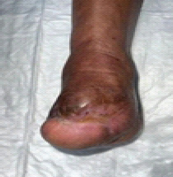 Figure 5: Final follow-up clinical photograph demonstrating complete wound healing with a stable, plantigrade foot suitable for weight-bearing.