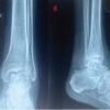Serratia Marcescens Septic Arthritis of the Ankle in a Compromised Host: Ring Fixator Arthrodesis as Salvage, a Case Report