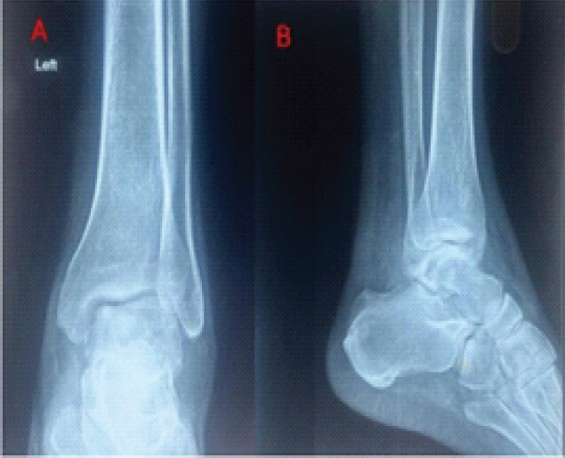 Figure 1: Pre-operative AP and lateral radiographs of the left ankle. The images demonstrate periarticular soft-tissue swelling, periarticular osteopenia, and early tibiotalar joint space narrowing without cortical erosion or frank bony destruction. AP: Anteroposterior.