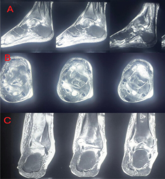 Figure 2: Pre-operative MRI of the left ankle – sagittal (a), axial (b), and coronal views (c). T2 and short tau inversion recovery sequences demonstrating diffuse synovial thickening, complex joint effusion, and subchondral bone marrow edema involving the tibial plafond and talar dome, consistent with septic arthritis. MRI: Magnetic resonance imaging.