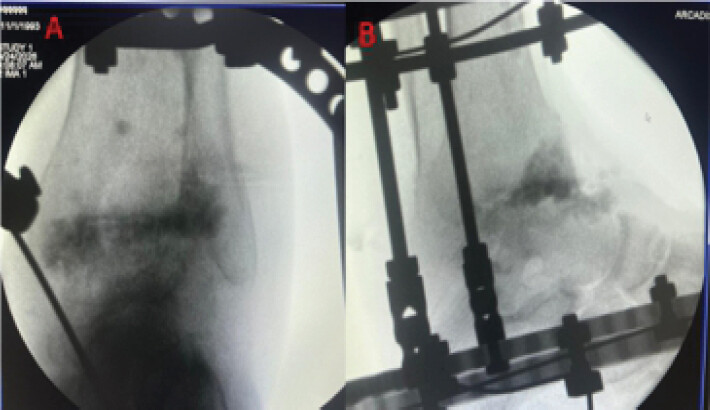 Figure 3: Immediate post-operative anteroposterior (a) and lateral radiographs (b) of the left ankle following ring fixator-assisted ankle arthrodesis. The images demonstrate the Ilizarov ring fixator in situ, spanning the distal tibia and hindfoot, with transfixing olive wires passing through the talus and calcaneus with antibiotic calcium sulfate crystals. Satisfactory bone apposition and neutral ankle alignment were confirmed.