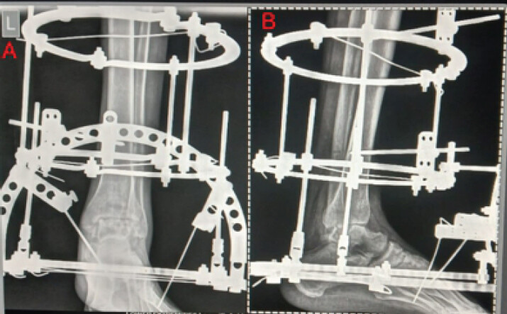 Figure 4: Radiographs of the left ankle at 6 months follow-up demonstrate progressive trabecular bridging across the arthrodesis site, suggestive of ongoing union. The ring fixator remains in situ and has been dynamized to enable controlled axial load sharing. No recurrence of infection or implant-related complication is evident.