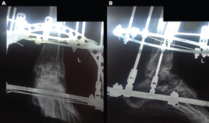 Figure 5: AP (a) and lateral (b) radiographs of the left ankle at 9-month follow-up, following ring fixator-assisted arthrodesis. The images demonstrate progressive trabecular bridging across the tibiotalar arthrodesis site with the Ilizarov frame in situ, consistent with ongoing bony consolidation. AP: Anteroposterior.