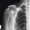 Stress-Related Acromion Base Fracture after Clavicular Hook Plate Fixation: A Case Report