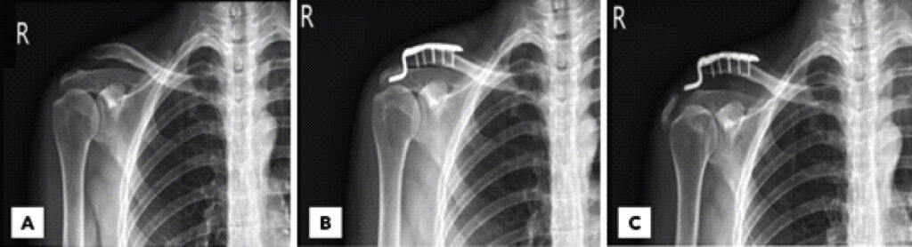 Figure 1: Radiographic evaluation of the right shoulder before and after clavicular hook plate fixation. (a) Anteroposterior radiograph demonstrating a Rockwood Type V acromioclavicular joint dislocation. (b) Post-operative anteroposterior radiograph showing reduction of the acromioclavicular joint after clavicular hook plate fixation. (c) Radiograph obtained 2 months after surgery demonstrating a peri-implant fracture involving the acromion.