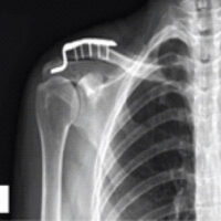 Figure 1: Radiographic evaluation of the right shoulder before and after clavicular hook plate fixation. (a) Anteroposterior radiograph demonstrating a Rockwood Type V acromioclavicular joint dislocation. (b) Post-operative anteroposterior radiograph showing reduction of the acromioclavicular joint after clavicular hook plate fixation. (c) Radiograph obtained 2 months after surgery demonstrating a peri-implant fracture involving the acromion.