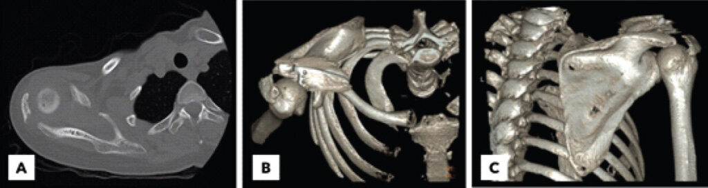 Figure 2: Computed tomography evaluation of the acromial base fracture. (a) Axial computed tomography image demonstrating an intact acromial fracture fragment with 15-mm diastasis. (b) Superior-view three-dimensional computed tomography reconstruction showing a fracture at the base of the acromion. (c) Posterior-view three-dimensional computed tomography reconstruction demonstrating inferior displacement of the acromial fragment with associated subacromial impingement.