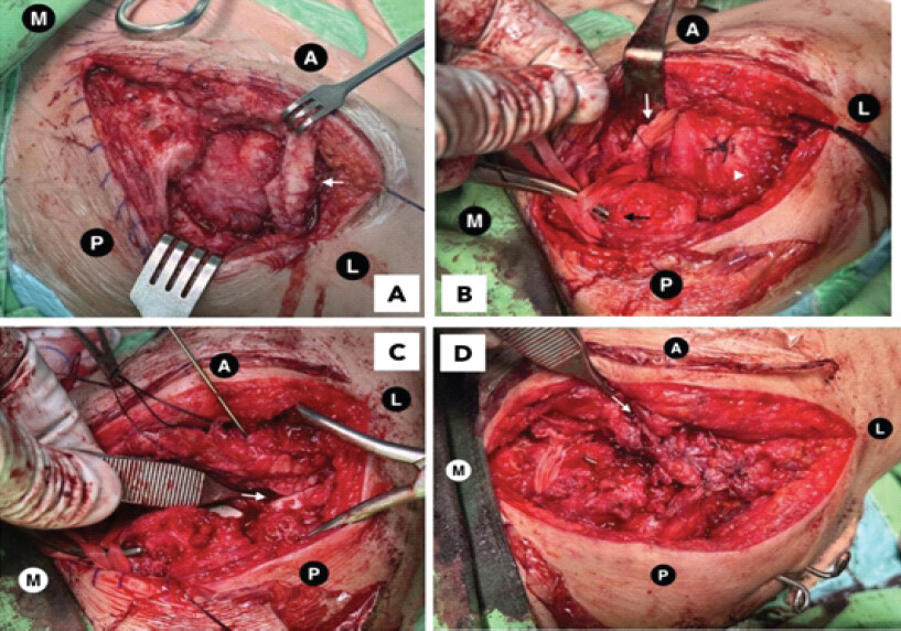 Figure 3: Intraoperative findings and surgical management of the acromial base fracture. Orientation markers (A: Anterior; P: Posterior; M: Medial; L: Lateral) are labeled for spatial reference. (a) Intraoperative photograph obtained through a superolateral approach demonstrating an intact acromial fragment without fragmentation (white arrow). (b) Intraoperative photograph showing the coracoacromial ligament tagged with a stay suture for coracoclavicular ligament reconstruction (white arrow) and two Mersilene tapes passed through the coracoid process for augmentation (black arrows). A partial rotator cuff tear was identified and repaired with sutures (arrowhead). (c) Intraoperative image demonstrating reduction of the acromial fragment with temporary fixation using a 2.0-mm Kirschner wire (white arrow). (d) Intraoperative image showing repair of the acromioclavicular capsule with interrupted sutures following acromioclavicular joint reduction and coracoclavicular ligament reconstruction (white arrow).