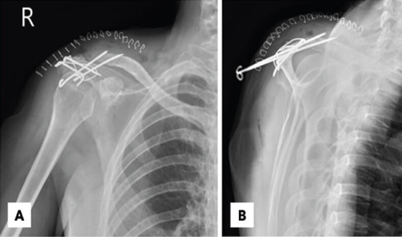 Figure 4: Post-operative radiographic evaluation of the right shoulder. (a) Post-operative anteroposterior radiograph demonstrating satisfactory reduction of the acromioclavicular joint. (b) Post-operative scapular Y-view radiograph confirming maintained alignment of the acromioclavicular joint.