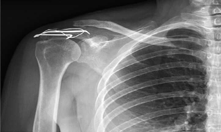 Figure 5: Follow-up radiographic evaluation at three months postoperatively. Anteroposterior radiograph of the right shoulder demonstrating consolidation of the acromial fracture with maintained acromioclavicular joint alignment.