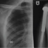 Delayed Metachronous Multicentric Giant Cell Tumor of Bone after a 16-Year Disease-Free Interval: A Case Report