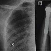 Figure 1: (a) Plain radiograph of the right shoulder demonstrating a lytic, expansile lesion involving the proximal humerus consistent with giant cell tumor of bone at the initial presentation. (b) Post-operative radiograph following wide resection of the proximal humerus and reconstruction with a proximal humeral endoprosthesis, showing satisfactory implant position and alignment.