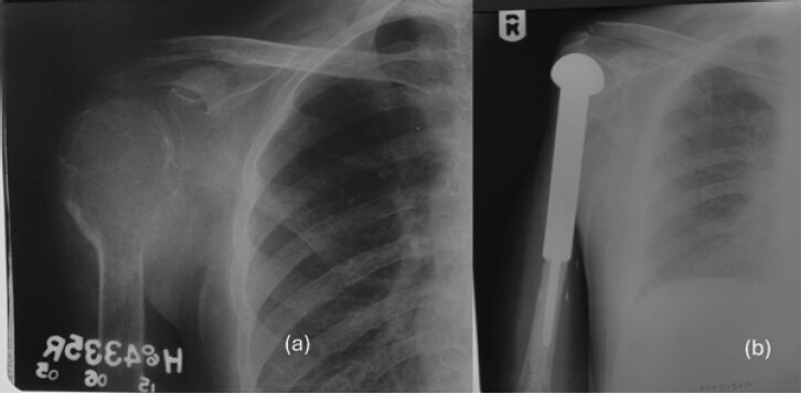 Figure 1: (a) Plain radiograph of the right shoulder demonstrating a lytic, expansile lesion involving the proximal humerus consistent with giant cell tumor of bone at the initial presentation. (b) Post-operative radiograph following wide resection of the proximal humerus and reconstruction with a proximal humeral endoprosthesis, showing satisfactory implant position and alignment.