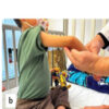 Surgical Management of Exceptionally Severe Cubitus Varus Deformity in Osteogenesis Imperfecta: A Case Report