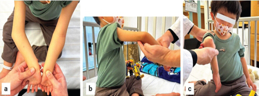 Figure 1: The patient’s appearance at the initial visit. (a) The anterior view of the right elbow shows severe varus deformity. (b) The right elbow extension was approximately 20°. (c) The right humerus showed marked internal rotation.