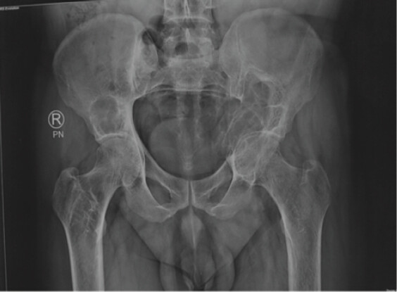 Figure 2: Anteroposterior radiograph of the pelvis demonstrating a well-defined expansile osteolytic lesion involving the left periacetabular region and iliac bone with cortical thinning and trabecular destruction, representing the first radiographic evidence of metachronous recurrence following a prolonged disease-free interval.