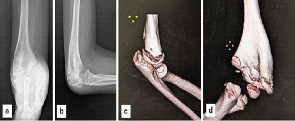 Figure 2: X-ray and 3D computed tomography (CT) images at the time of initial visit to our hospital. X-ray (a): Anteroposterior view, (b): Lateral view, and 3D CT images (c): Lateral view, (d): Posterior view show marked varus deformity of the humerus and non-union of the lateral condyle fracture.