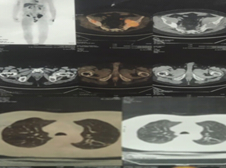 Figure 3: Whole-body 18F-Fluorodeoxyglucose positron emission tomography–computed tomography (PET-CT) evaluation. (a) Maximum-intensity-projection image showing metabolically active lesions in the pelvis and bilateral proximal femora. (b) Fused PET-CT showing the bilateral iliac lesions. (c) Corresponding CT image demonstrating iliac bone destruction. (d) Fused PET-CT showing bilateral femoral-neck involvement. No pulmonary metastases or additional skeletal lesions were detected.