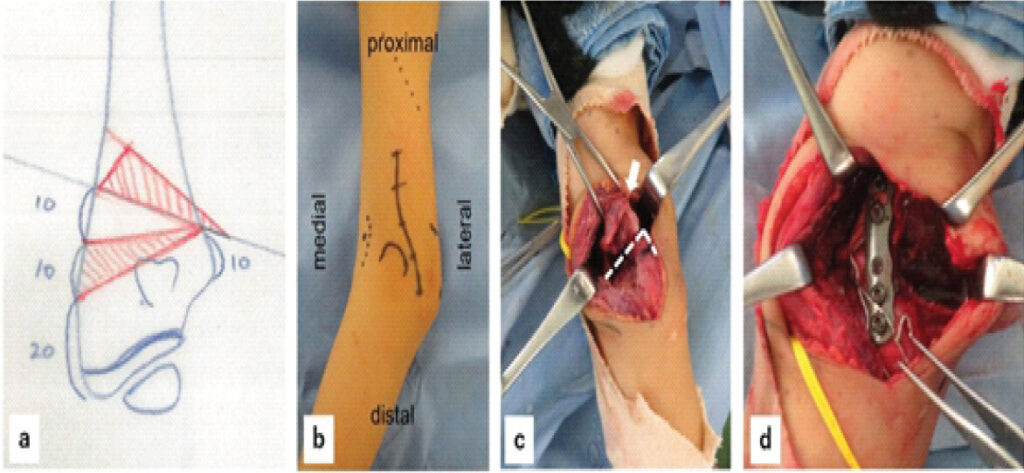 Figure 3: Surgical plan and surgical findings. (a) Osteotomies were performed in a step-like fashion in the sagittal plane so that the red-lined areas would overlap, with a planned valgus angle of approximately 45°. (b) A curved skin incision was made extending from the posterior to the lateral side of the right elbow. (c) The distal humerus was osteotomized in a stepped manner on the sagittal plane and in a triangular manner on the coronal plane, so that the osteotomy sites would make contact over a wide area. The white dotted lines indicate the edges of the osteotomy sites on the distal fragment. (d) The osteotomy site was stabilized using a plate and screws, as well as a Kirschner wire and soft wire.