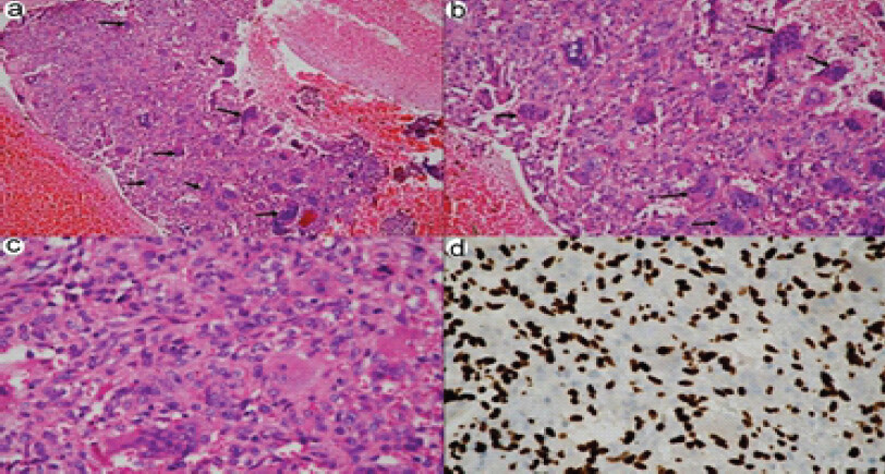 Figure 4: Histopathological examination of the lesion. Hematoxylin and eosin-stained sections demonstrate hemorrhage and a cellular tumor composed of numerous osteoclast-like multinucleated giant cells (black arrows) within a background of mononuclear stromal cells (a, Hematoxylin and Eosin [H&E] ×100; b, H&E ×200). The stromal cells are round to oval and focally spindle-shaped with fine chromatin, inconspicuous nucleoli, and pale eosinophilic cytoplasm (c, H&E ×400). Immunohistochemistry shows diffuse nuclear positivity for H3F3A G34W, confirming the diagnosis of giant cell tumor of bone (d, ×400).