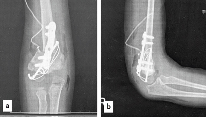 Figure 4: X-ray findings after the first surgery. (a): Anteroposterior view, (b): Lateral view.