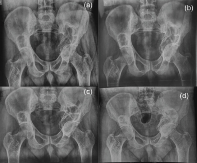 Figure 5: Serial pelvic radiographs showing progressive sclerosis of the left periacetabular giant cell tumor following zoledronic acid therapy. (a) Baseline radiograph demonstrating the osteolytic lesion. (b) One-year follow-up showing early sclerosis. (c) Two-year follow-up demonstrating further sclerosis and lesion stabilization. (d) Final follow-up showing marked sclerosis and osseous remodeling, consistent with a favorable radiological response.