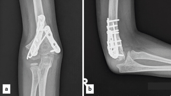 Figure 5: X-ray findings after the second surgery. The alignment of the humerus has been corrected, and the fracture site at the lateral condyle has healed well. (a): Anteroposterior view, (b): Lateral view.